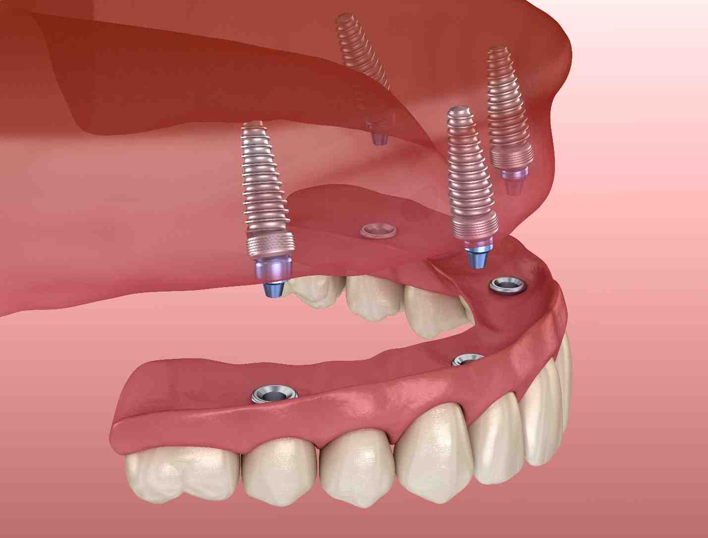 Can a dental implant be done in one day?