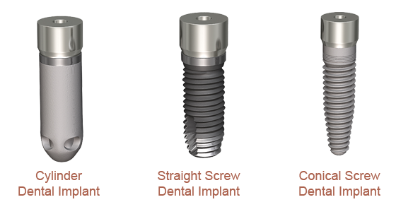 Can a dental implant screw fell out?