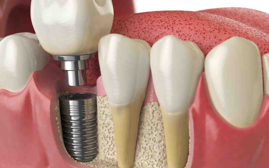 Can a tooth implant be rejected?