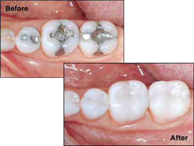 Can cosmetic dentist do fillings?