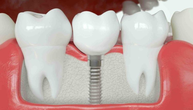 Can dental implant crowns be repaired?