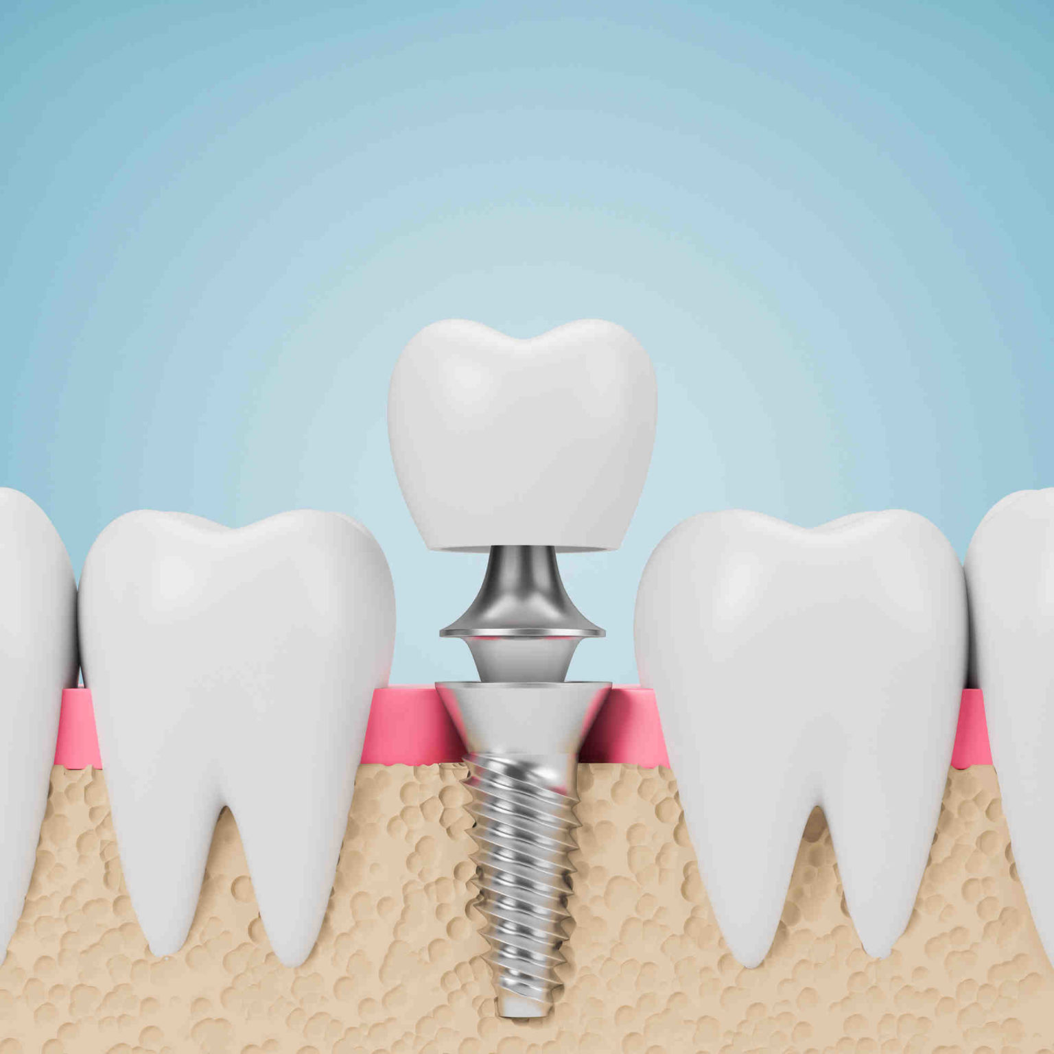 Can you get a dental implant years after extraction Dental News Network