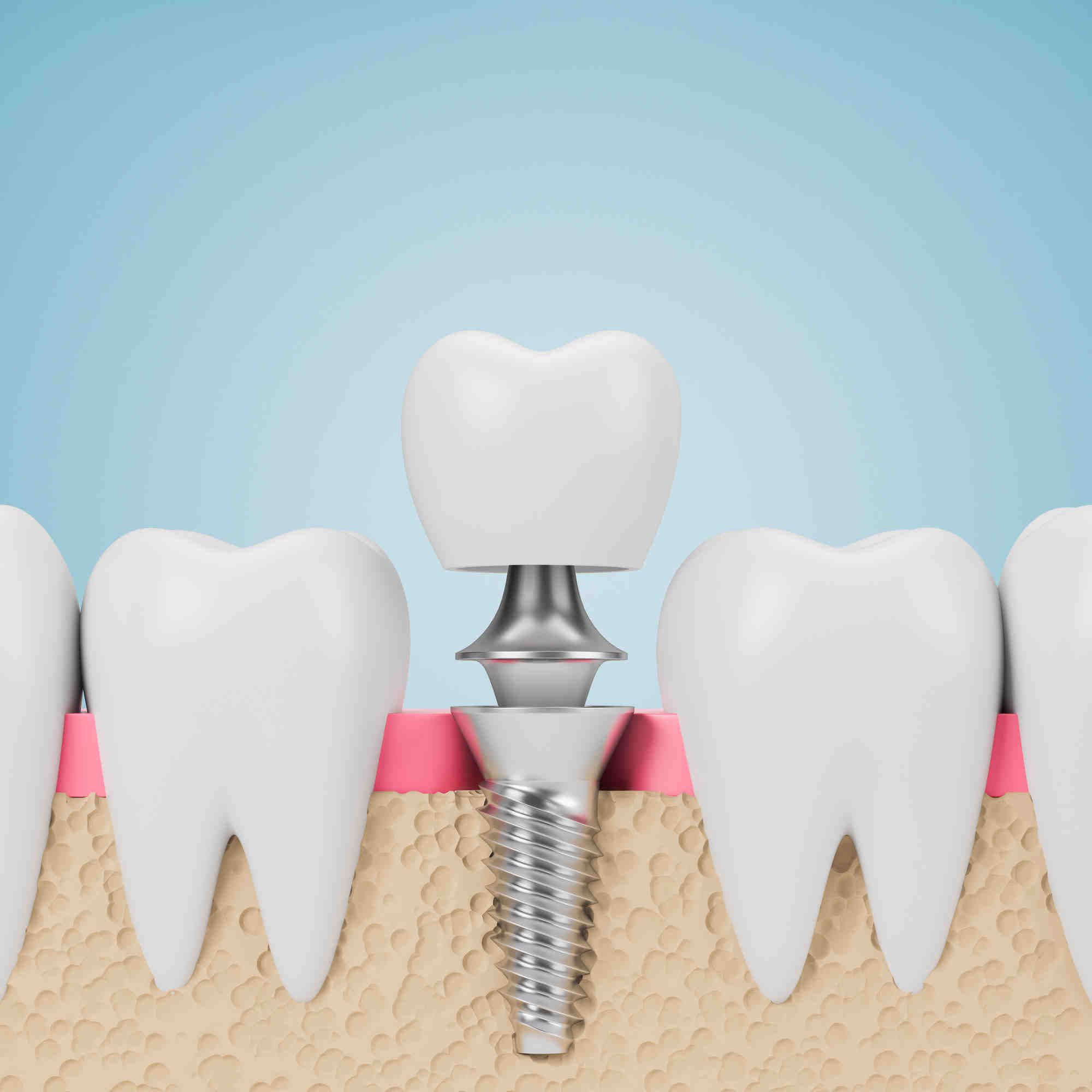 Can you get a dental implant years after extraction Dental News Network