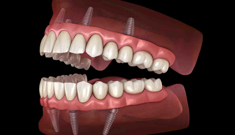 Can dental implants be removed and replaced with dentures