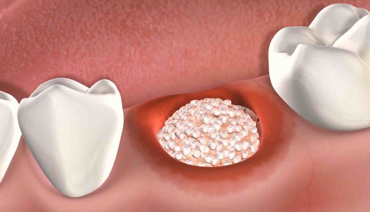 Can you drink wine after a dental implant