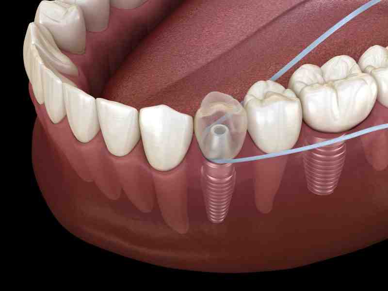 How to floss around a dental implant Dental News Network