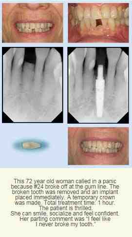 Can you get Implant same day as extraction?