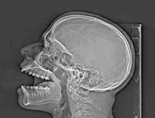 Can you get a CT scan with titanium?