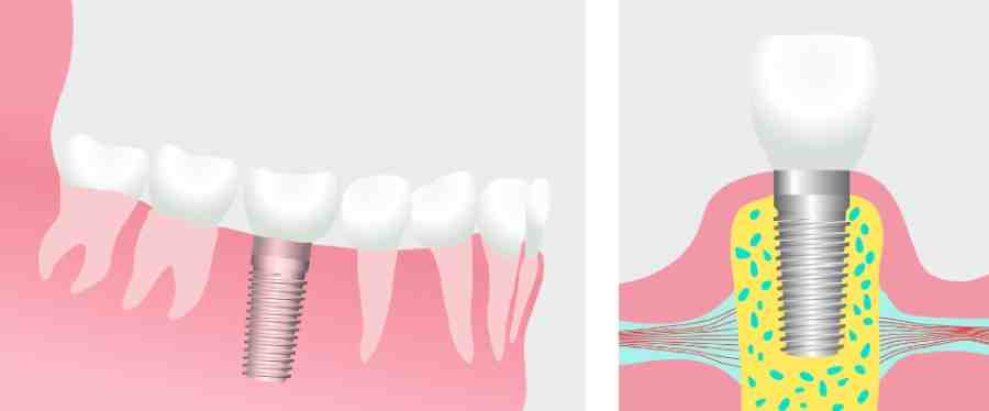 Can you get a dental implant without a bone graft?