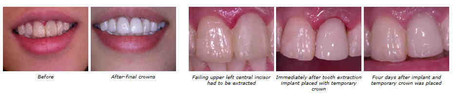 Can you get a temporary tooth while waiting for an implant?