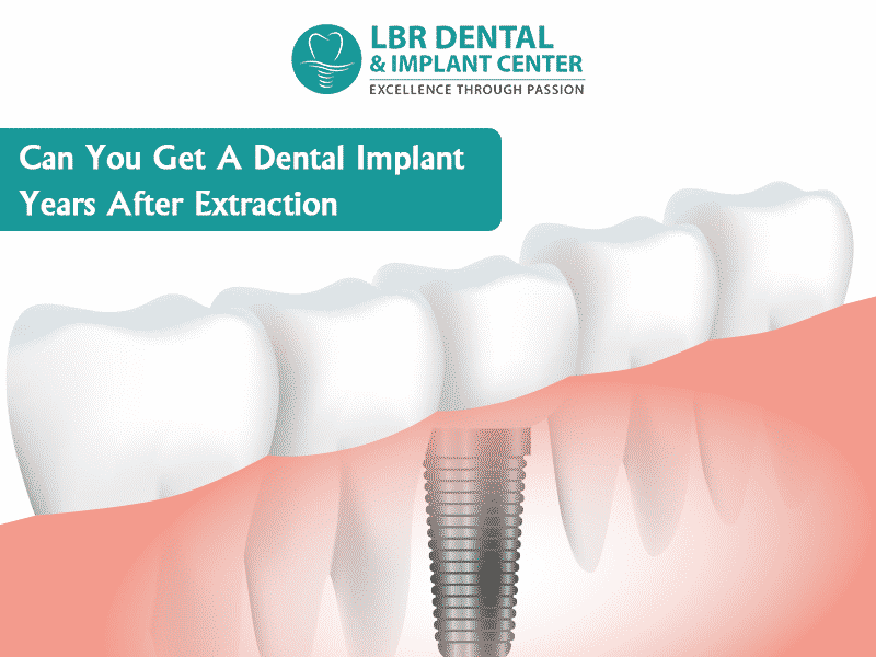 Can dental implants be placed immediately after extraction Dental