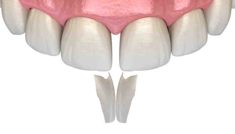 Cosmetic dentistry file down teeth