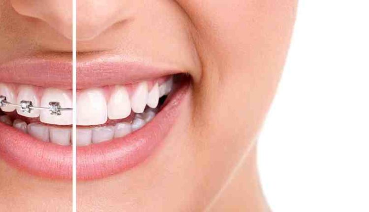 Cosmetic dentistry for fluoride