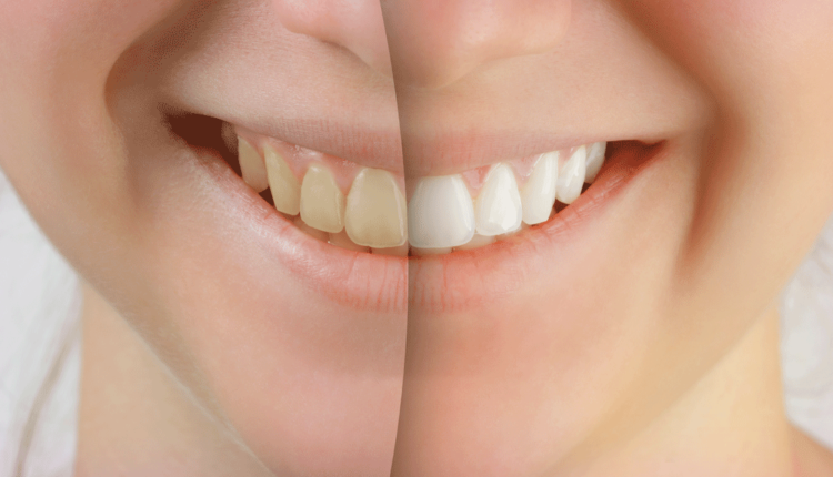 Cosmetic dentistry for kids