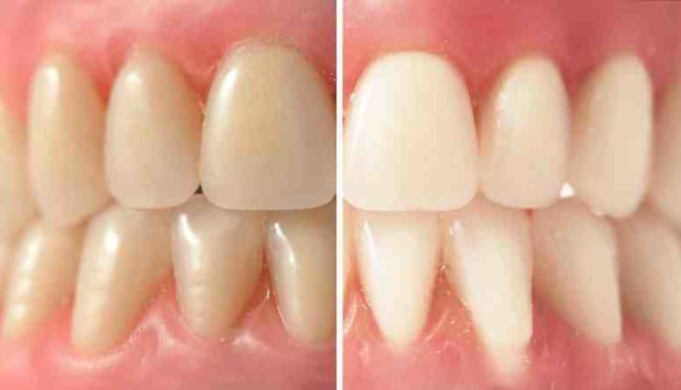 Cosmetic dentistry for seniors to improve teeth color