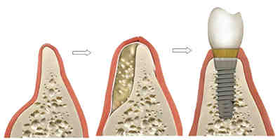 Do all implants require bone graft?