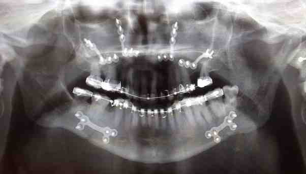 Do dental implants cause problems at airport security?