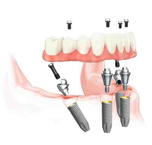Do dental implants look fake Dental News Network