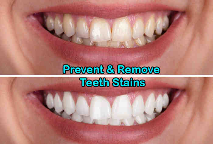Do dental implants get stained?