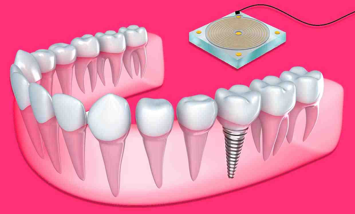 Do dental implants look natural?