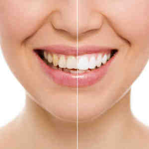 Do dental implants stay white?