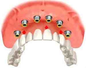 Do dental savings plans cover implants?