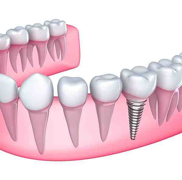 Do dental implants set off metal detectors Dental News Network