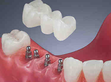 Do mini dental implants last?