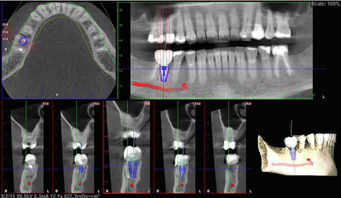 Do you need a CT scan for implants?