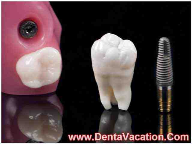 Does clear choice really do implants in one day?