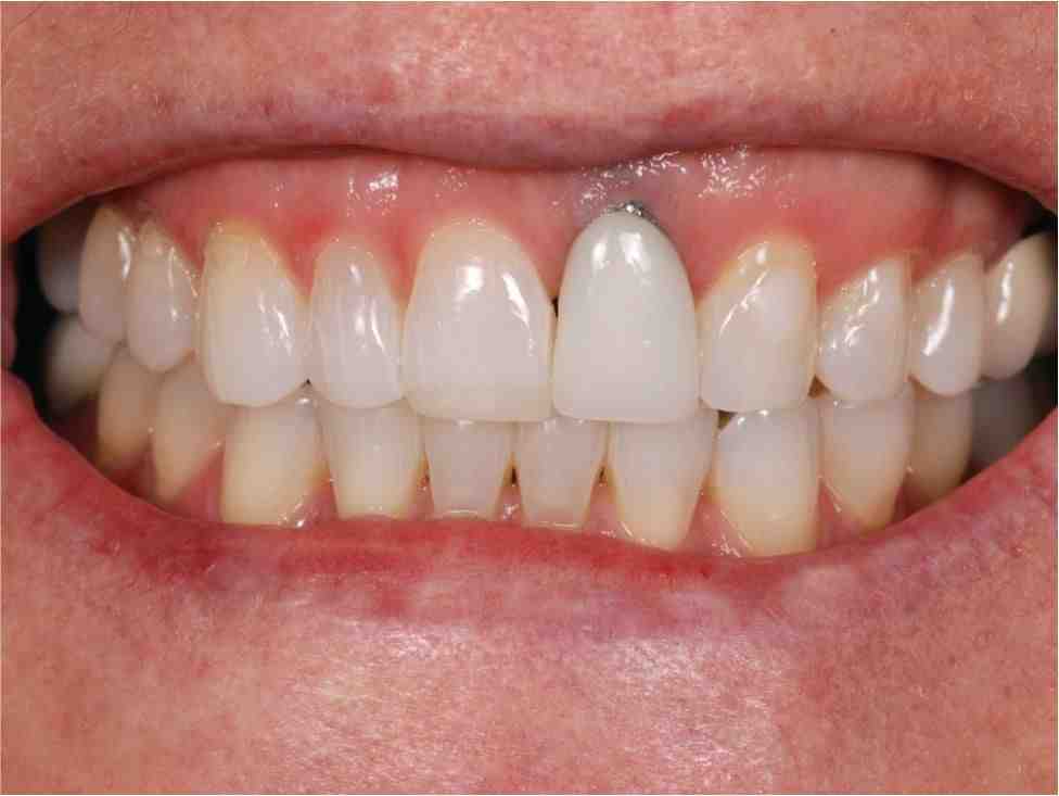 Does food get under dental implants?