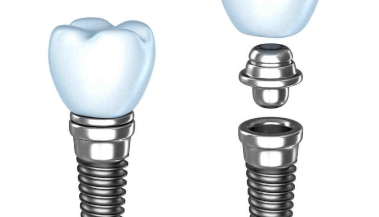 Does fsa cover dental implants