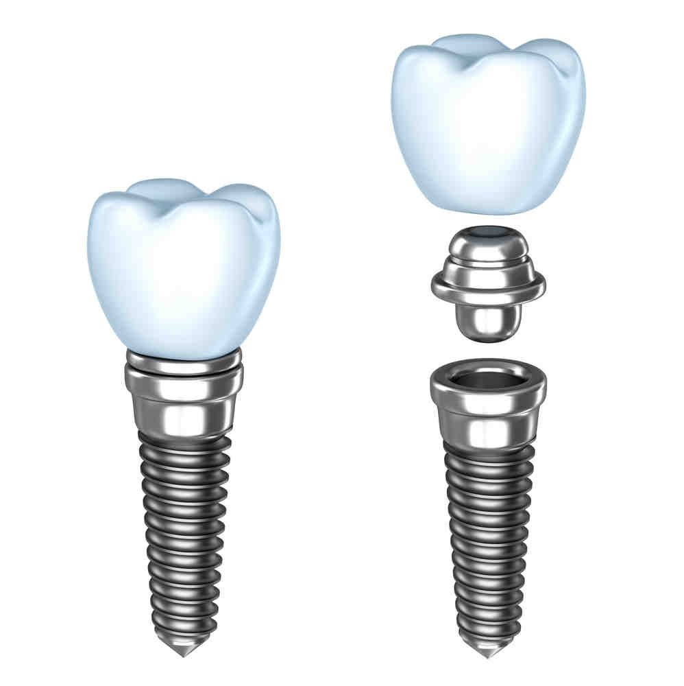 Does fsa cover dental implants Dental News Network