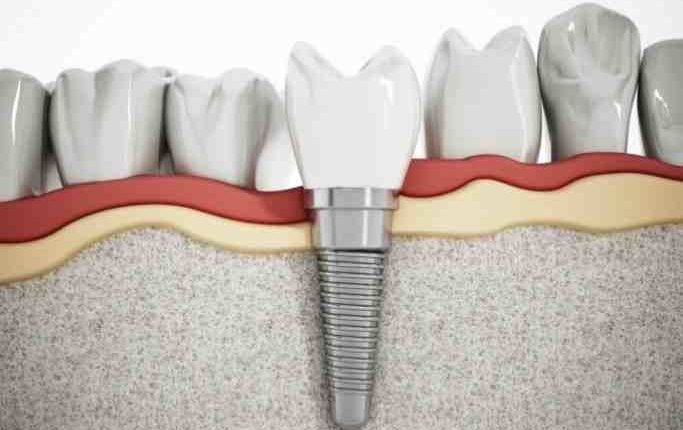 Does hip plus cover dental implants