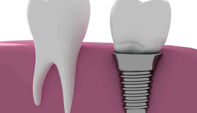 does-medical-insurance-cover-dental-implants-dental-news-network