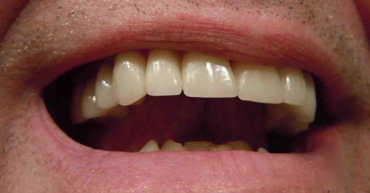 How A dental implant is done?