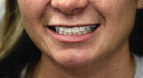 How Much Does a full dental makeover cost?