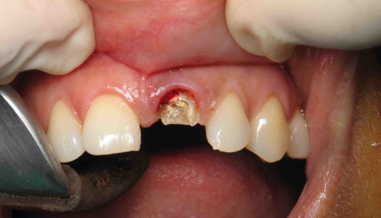 How bad does a dental implant hurt