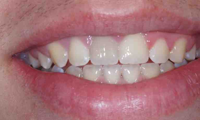 How can I fix my teeth with no money?