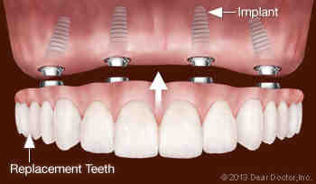 How can I get free dental implants?