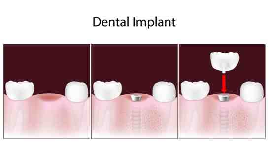 How can I get free dental implants?