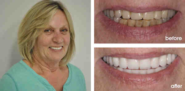 How can I get my teeth fixed with no money?