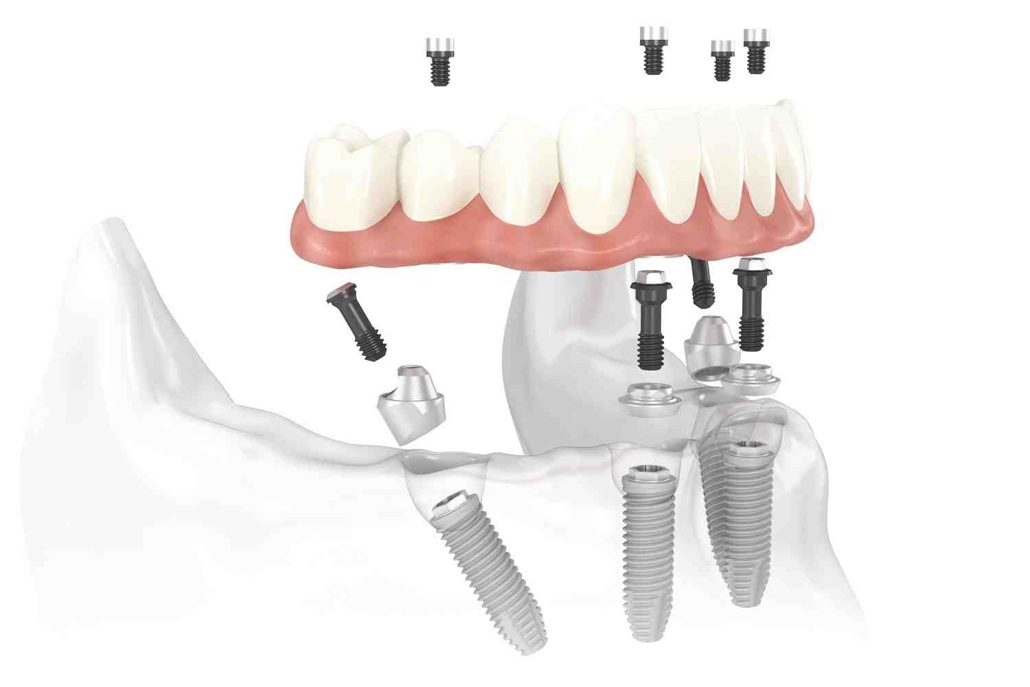 How can I replace my teeth without implants?