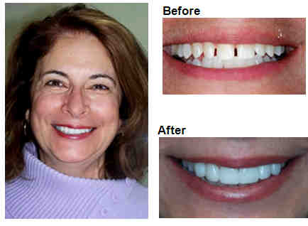 How can I whiten my older teeth?