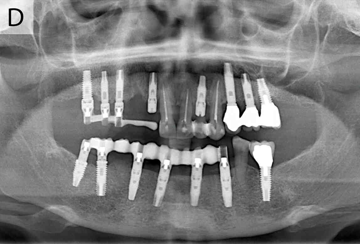 Рентгена 4. Снимки ОПТГ зубов с кариесом. Импланты Штрауман ОПТГ.