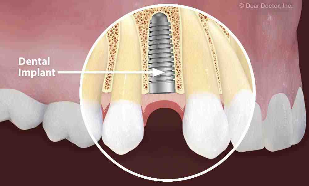 Can dental implants be removed and replaced with dentures Dental News
