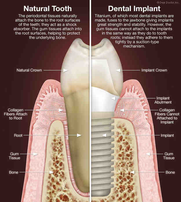 How to take care of dental implants Dental News Network