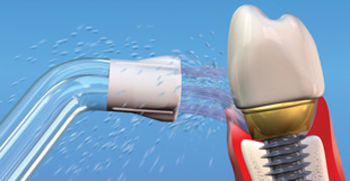 How do you clean under dental implants?