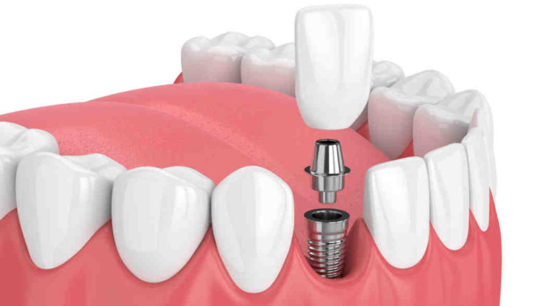 How expensive is a dental implant