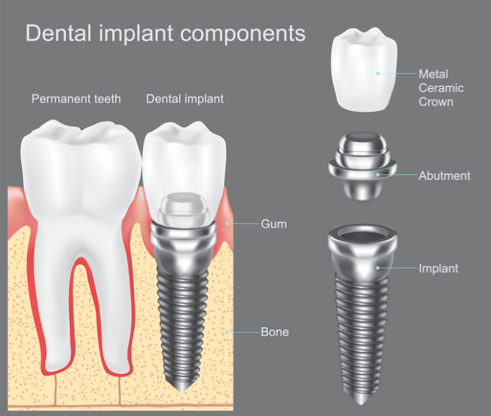 How long after dental implants can I eat normally?